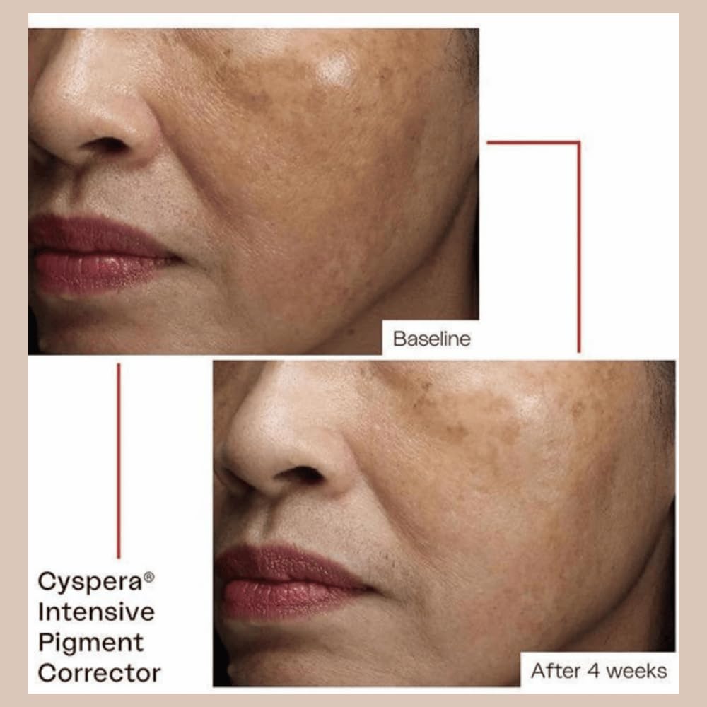 Cyspera Cysteamine Intensive Pigment 50g