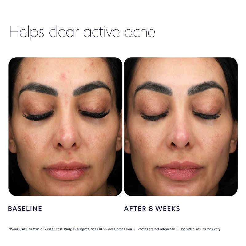 PCA SKIN - Acne Control Prebiotic Gel Cleanser - 207ml